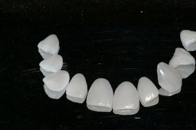 As lentes de contato cobrem os dentes naturais Foto: Fabiano Antunes/Divulga&ccedil;&atilde;o/JC