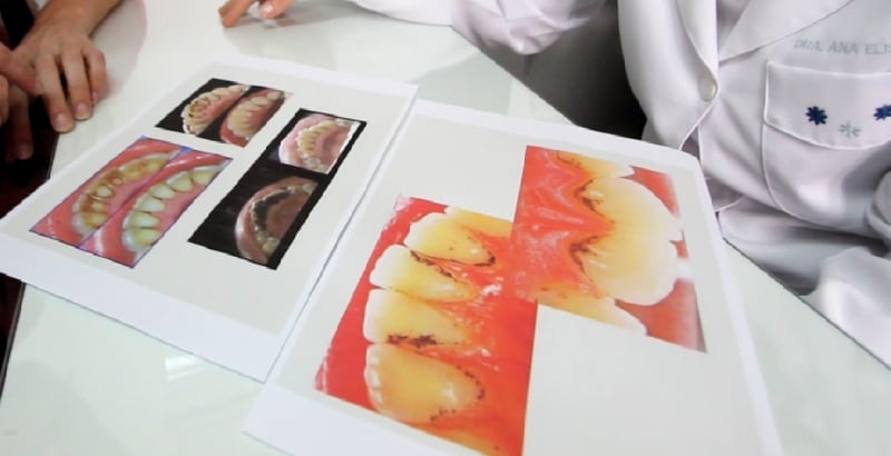 A dentista Ana Elisa explica como se forma a pigmentação nos dentes e alerta para cuidados e tratamento