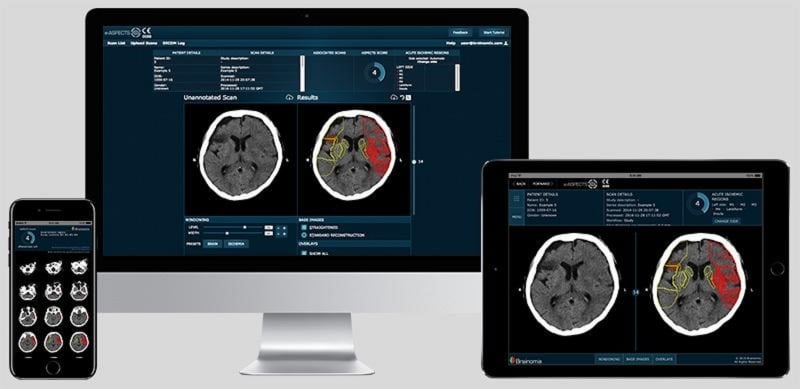 Empresa inglesa desenvolveu o e-Aspects, que auxilia na identificação precoce de dano isquêmico