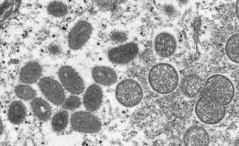 A doença rara e infecciosa é causada pelo vírus monkeypox e ocorre principalmente na África
