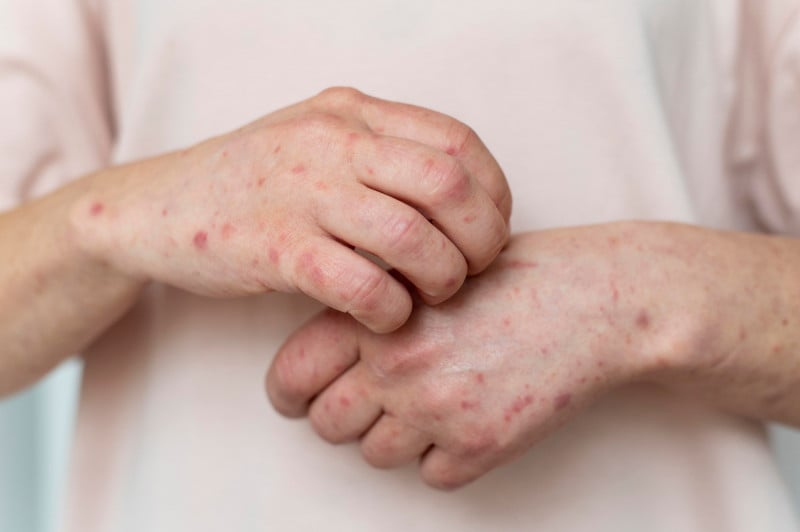 Ampliação para lúpus eritematoso sistêmico pediátrico vale para apresentações em caneta aplicadora ou autoinjetora