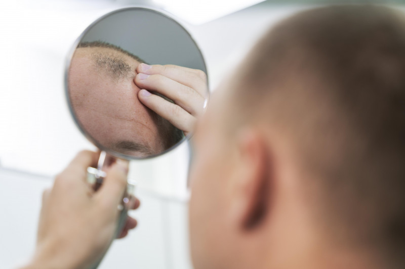 A alopecia areata atinge entre 1% a 2% da população brasileira