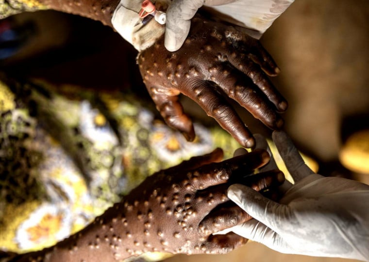 Com 93 confirmações, o estado de São Paulo lidera o ranking nacional