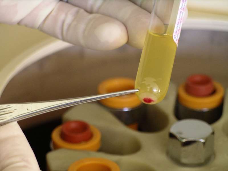 Plasma convalescente será introduzido no corpo mediante transfusão de sangue